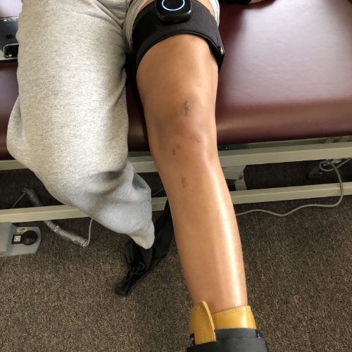 Blood-flow-restriction-Advance-Orthopedic-and-Sports-Therapy-Tewksbury-MA