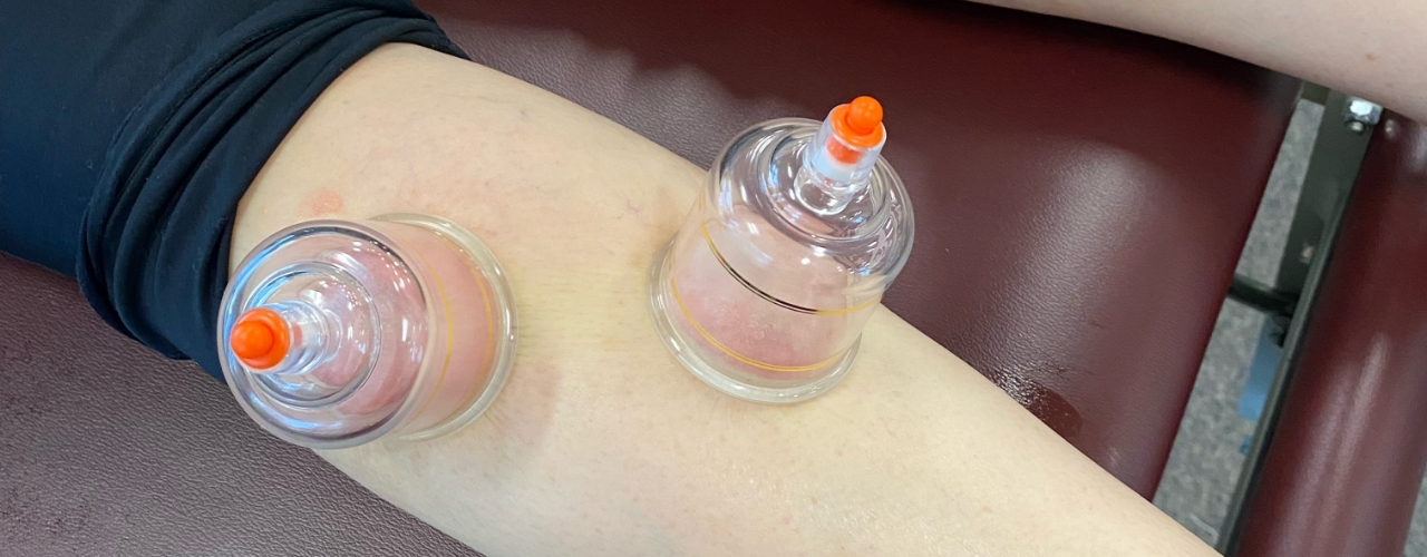 Cupping-Advance-Orthopedic-and-Sports-Therapy-Tewksbury-MA