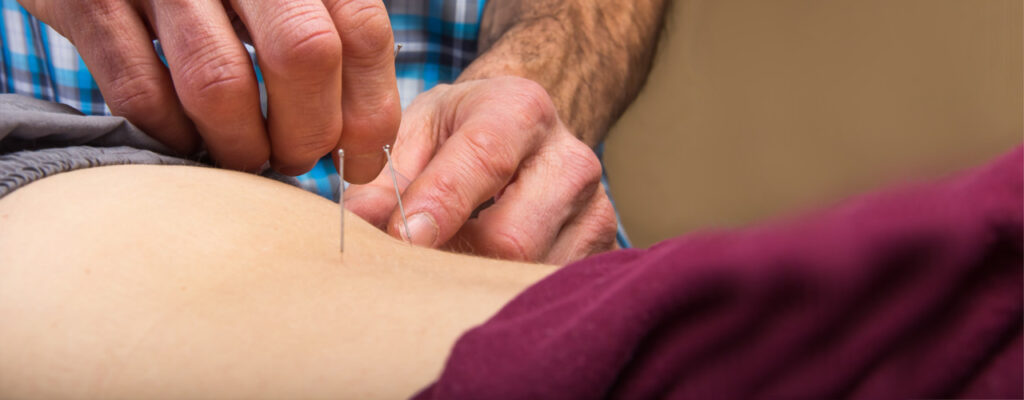 Dry-Needling-Blog-Post-Advance-Orthopedic-and-Sports-Therapy